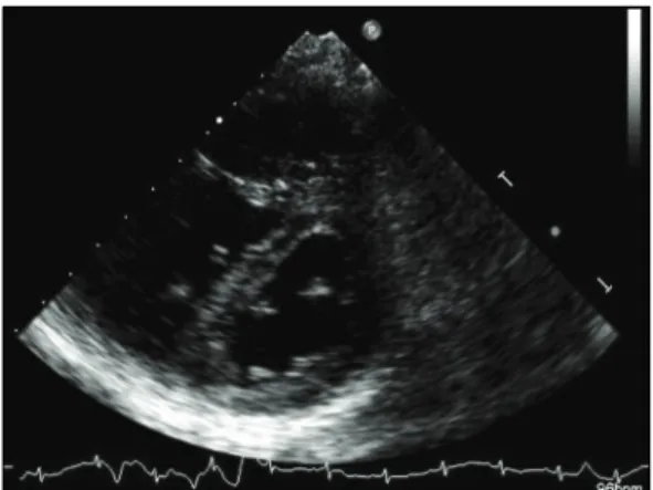 Fig.  2.  Transthorasic  echocardiography  shows  D-shape  left  ventricular  cavity. 좌심실이  D  모양으로  관찰되었고  추정  수축기  폐동 맥압이  75.3  mmHg로  증가된  소견을  보였다(그림  2)