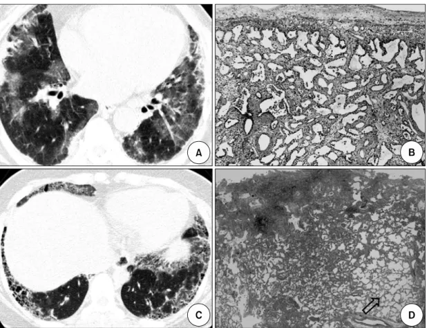 Fig.  2.  Typical  HRCT  and  histologic  features  of  NSIP  (A,  B)  and  UIP  (C,  D)  associated  with  connective  tissue  diseases  (A)  Patchy  areas  of  consolidation  and  wide  spread  ground-glass  attenuation  are  seen  in  both  subpleural  