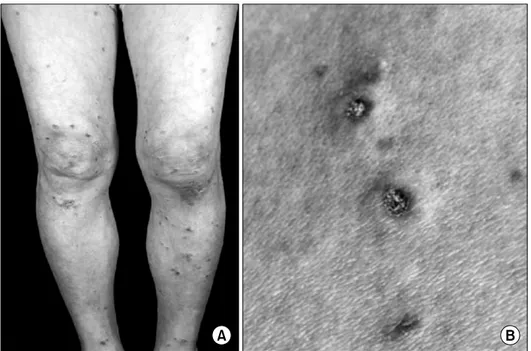 Fig. 1. Photographs  of  skin  lesion.  Multiple  discrete  papules  are  seen  on  both  legs  (A)  and  papules  have  white  atrophic  center  with  thin  erythematous  rim  (B).
