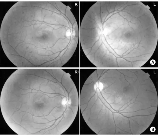 Fig.  1.  (A)  Fundus  photography  as  the  frist  episode  of  optic  neuritis.  Left  fundus  photography  shows  the  hyperemia,  edematous  change  and  blurring  around  optic  disc  and  right  fundus  photography  shows  normal  optic  disc