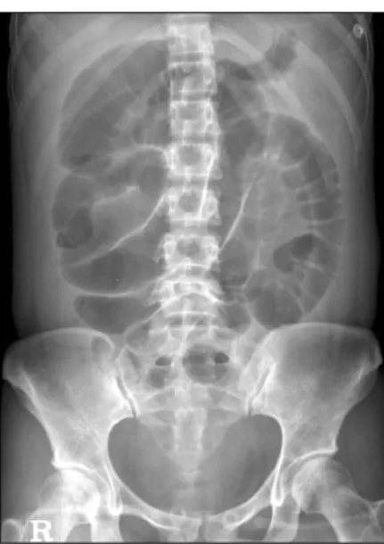 Fig.  1.  Simple  abdomen  supine  view  shows  severe  small  bowel  dilatation  and  diffuse  haziness