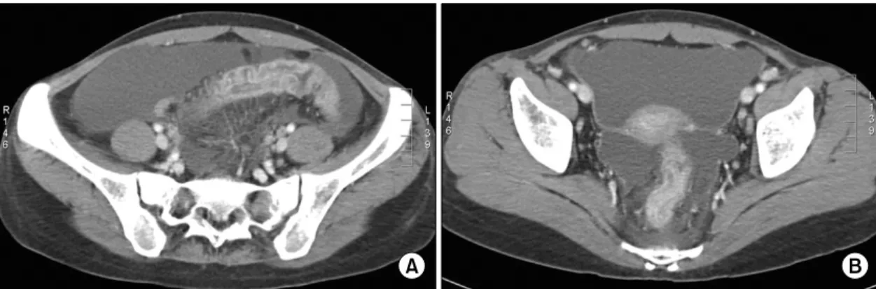 Fig.  3.  (A)  Enhanced  abdominal  CT  scan  shows  benign  circumferential  wall  thickening,  patch  wall  enhancement  of  the  sigmoid  colon,  and  mesenteric  vascular  engorgement,  which  are  compatible  with  inflammatory  and  ischemic  changes