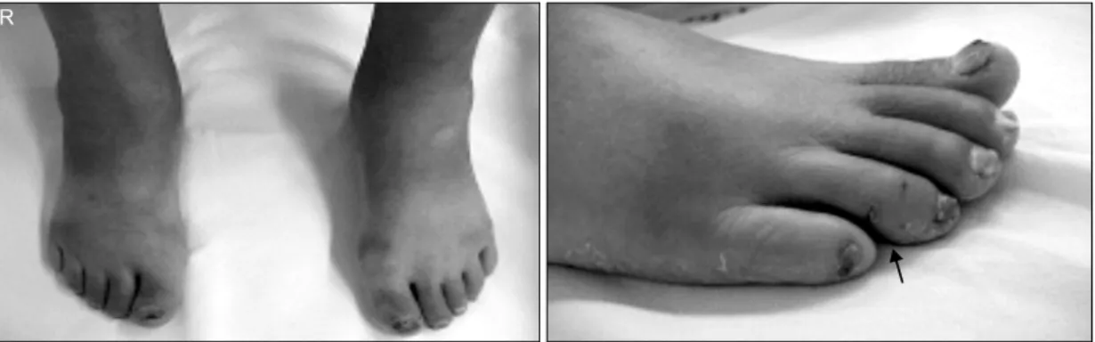Fig.  1.  The  picture  shows  arthritis  of  the  right  ankle  and  midtarsal  joint  with  the  site  of  the  rat  bite  (arrow),  which  had  healed
