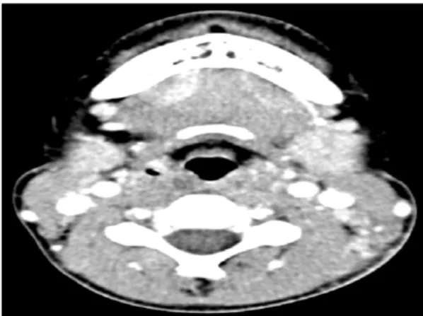 Fig.  1.  Neck  computed  tomography  (CT)  scan  showed  multiple  lymphadenopathies.수개월에  걸쳐  자연  호전  되는  것으로  알려져  있으며,  재발률은  3∼5%  정도로  알려져  있다  (4)