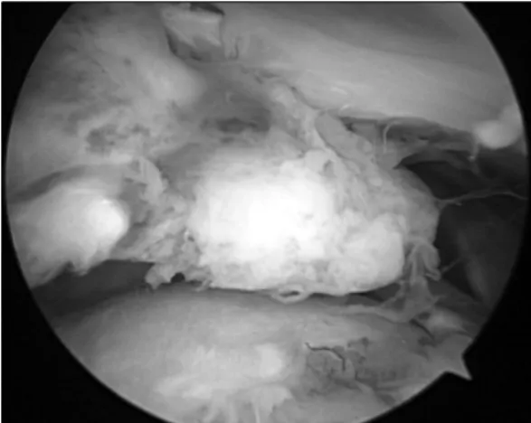 Fig.  13. Blood  clot  on  torn  margin  suggests  acute  on  chronic  rotator  cuff  tear.