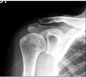 Fig.  2. Acromiohumeral  distance  is  less  than  7  mm.