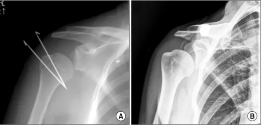 Fig.  6. (A)  Inferior  subluxation  of  humeral  head  on  glenohumeral  AP  view  taken  2  weeks  after  operation