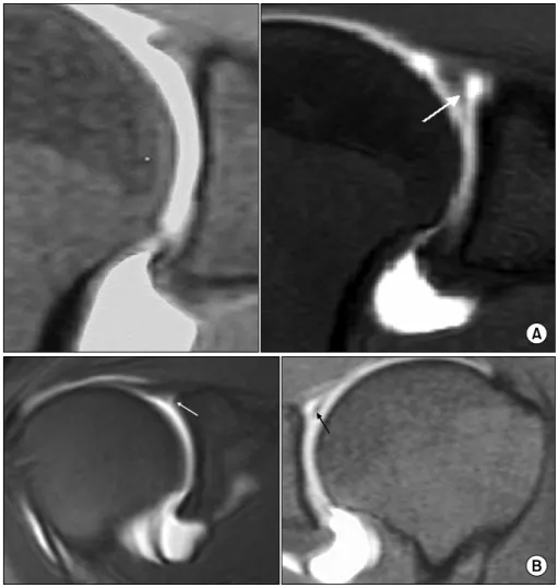 Fig.  7.  (A)  (left)  High  signal  intensity  not  extending  to  posterior  portion  of  superior  labrum,  (right)  high  signal  intensity  (arrow)  in  posterior  third  of  superior  labrum