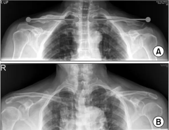 Fig.  8. (A)  Shortening  of  right  clavicle  after  conservative  treatment.  (B)  Malunion  of  left  clavicle.