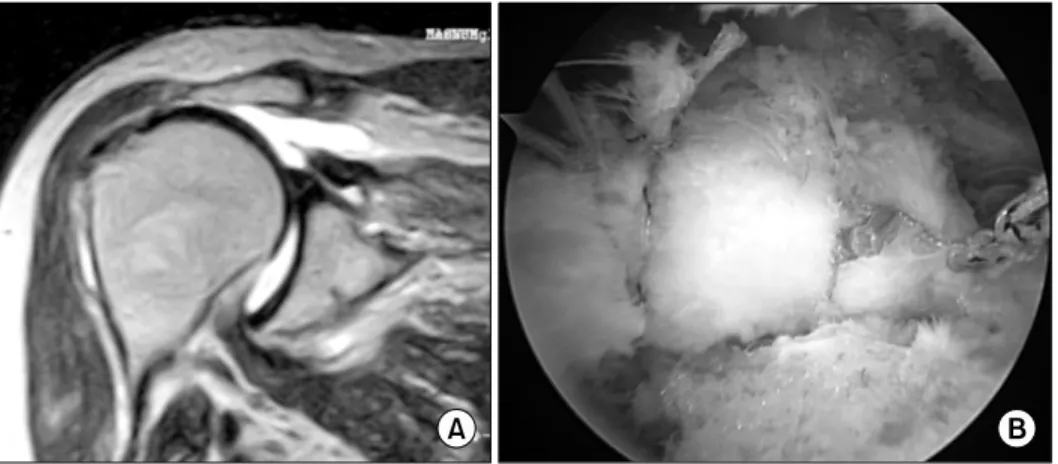 Fig.  10. (A)  Massive  rotator  cuff  tear  on  MRI  scan  of  right  shoulder.  (B)  Even  massive  rotator  cuff  tear  can  be  repaired  satisfactorily.