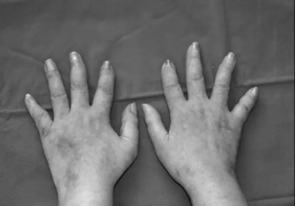 Fig. 1. Shortening  of  digits  with  deformity  of  distal  interphalangeal  joints  was  showed  on  both  hands.