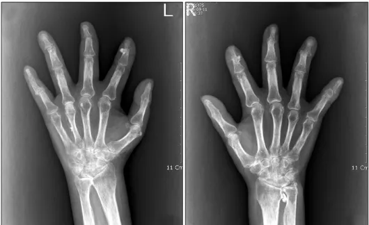Fig. 2. Simple  radiographs  of  both  hands  show  that  periarticular  osteopenia,  joint  space  narrowing,  erosion  with  destruction  in  both  distal  interphalangeal  joints.