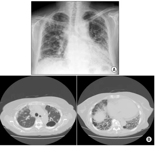 Fig. 3. Plain  radiography  of  chest  (A)  and  high  resolution  computed  tomography  of  lung  (B)  demonstrate  interstitial  infiltrates,  bullae  and  the  honeycombing  appearance  on  whole  lung  fields