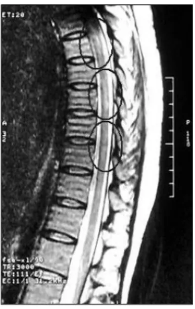 Fig. 3. Multiple  joint  space  narrow,  ankylosis,  and  deformities  of  both  hands  are  shown  in  the  radiograph.