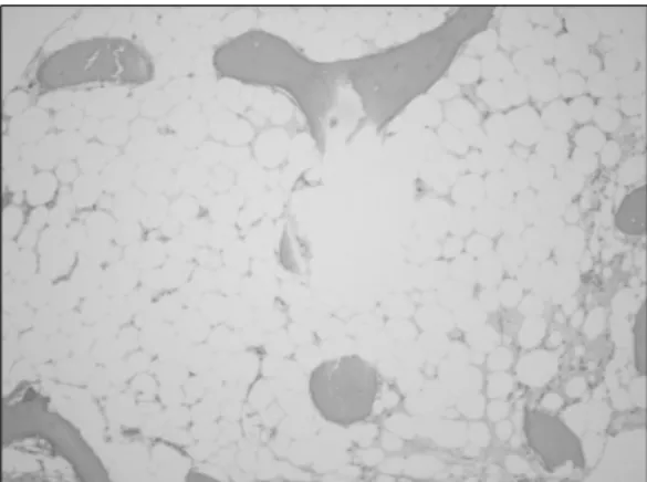 Fig.  1.  The  bone  marrow  biopsy  (H&amp;E  stain,  ×100).  The  specimen  shows  marked  hypocelluar  marrow  (cellualarity＜10%)