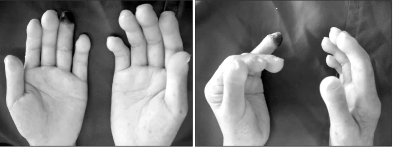 Fig.  1.  The  patient's  left  forth  finger  tip  is  swollen  and  shows  necrotic  change.서     론전신성  경화증은  만성적인  피부와  내부장기(소화기계,  폐,  심장,  신장)의  섬유화를  특징으로  하는  결체조직  질환이다  (1)