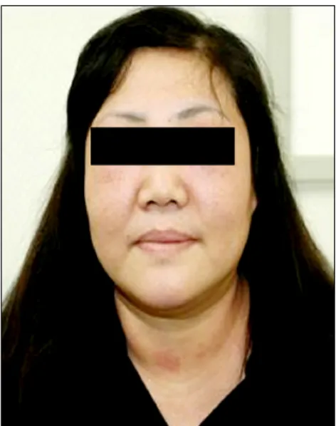 Fig.  1.  Heliotrope  rash  which  is  considered  pathogno- pathogno-monic  cutaneous  features  of  dermatomyositis.