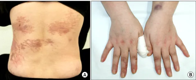 Fig.  2.  (A)  Poikilodermatous  lesions  on  the  back  at  the  first  presentation