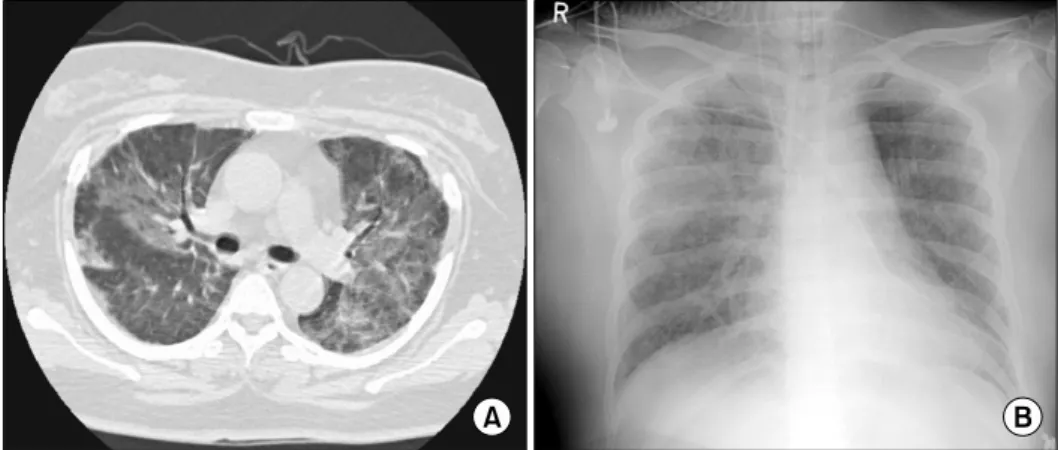 Fig.  4.  (A)  The  chest  HRCT  shows  ground  glass  opacity  along  the  bronchovascular  bundle  in  both  lung  fields  and  small  subpleural  nodules  in  right  upper  segment