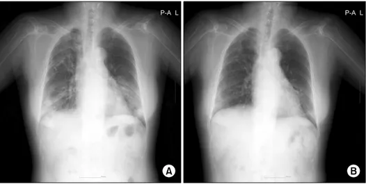 Fig.  1.  (A)  Multifocal  nodular  opacity  with  reticular  opacity  was  noted  in  both  lungs,  especially  both  lower  lobes  at  the  time  of  admission