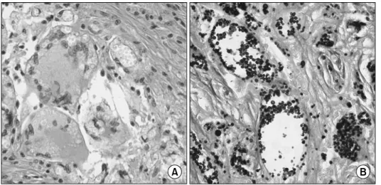 Fig.  2.  Throcoscopic  biopsy  stained  with  (A)  hematoxylin-eosin  stain  and  (B)  Grocott-Gomori  methenamine-silver  stain  shows  numerous  encapsulated  yeast-like  organisms  (×400).