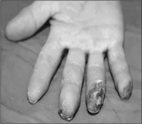 Fig.  1.  The  right  hand  of  the  patient  shows  ulcerations  of  the  third  to  fifth  fingers.