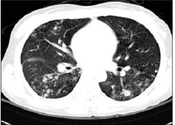 Fig.  3.  Chest  X-ray  showed  improved  lesion  of  both  upper  lung  fields  and  disappeared  previous  right  side  pleural  effusion.