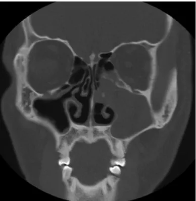 Fig. 2. Histopathological examination of specimen from maxillary  sinus; Keratinous material (Hematoxylin and Eosin ×40).