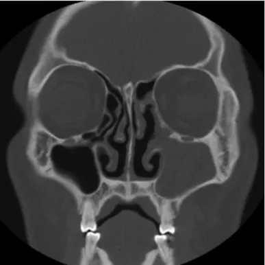 Fig. 4. Endoscopic finding of left maxillary sinus opening showing  whitish keratin material.