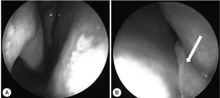 Fig. 1. Sinus endoscopy finding of nasal cavity. A: Right, normal finding, B: Left, visible antrochoanal polyp (white arrow).