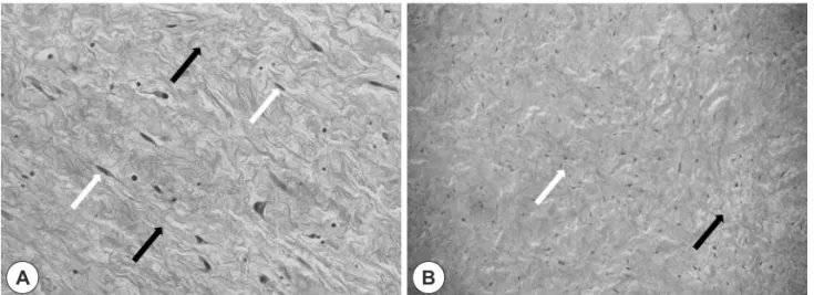 Fig. 3. Pathologic finding. A: Hypocellular collagenized myxoid stroma (black arrow), exhibiting bland spindle mesenchymal cells  (white arrow) (H&amp;E stain, ×200), B: Hypocellular, loosely arranged spindle-shaped stellate cells with a loose myxoid intra