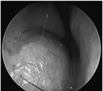 Fig. 1. Endoscopic finding of a soft tissue mass in the right nasal  floor. The mass has a round, reddish, and well-vascularized  ap-pearance.