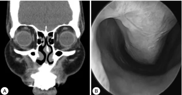Fig. 5. Pathologic findings. Microscopically, the mass was composed of spindle cells with irregularly dilated, staghorn-shaped vessels