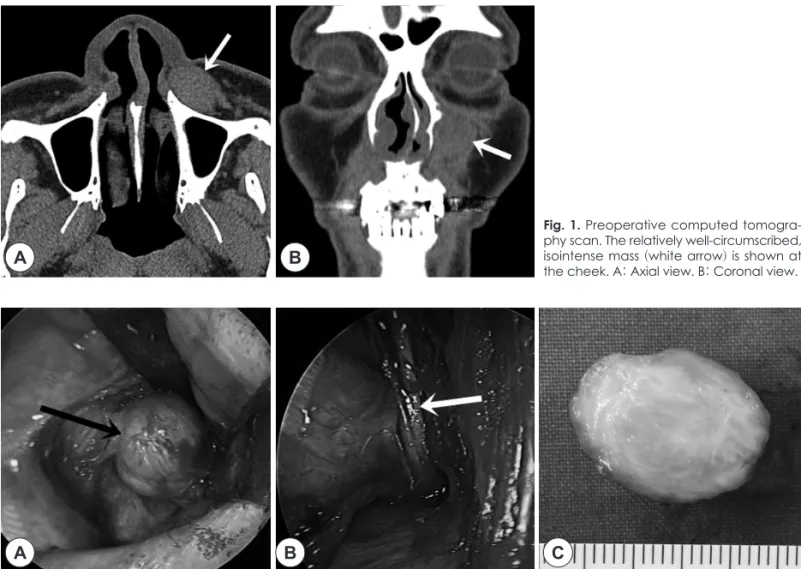 Fig. 1. Preoperative computed tomogra- tomogra-phy scan. The relatively well-circumscribed,  isointense mass (white arrow) is shown at  the cheek