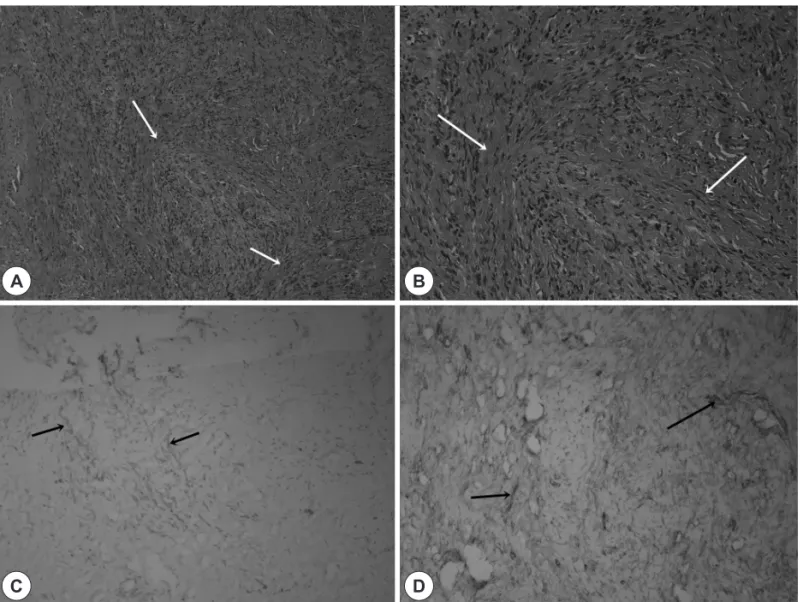 Fig. 3. Histopathologic findings. The mass consist of spindle cells with mixed collagen fibers (white arrow) which are arranged in pat- pat-ternless architecture (H&amp;E stain, A: ×100, B: ×200)