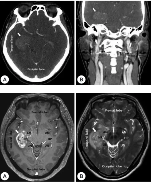 Fig. 1. Paranasal Sinus Computed Tomog- Tomog-raphy. A 3.4 cm-sized enhancing mass  (white arrow) in the right temporal lobe