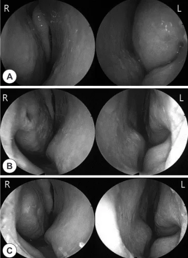 Fig. 1. Endoscopic views of the inferior turbinate. A: Preoperative. 