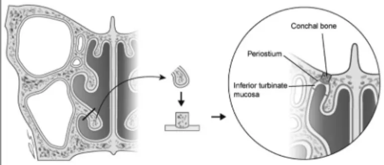 Fig. 1. Schematic illustration showing procedures of inferior turbi- turbi-nate bone-periosteum-mucosal composite free graft for skull  base defect.