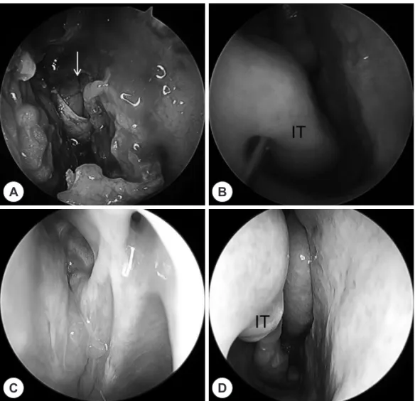 Fig. 4. Intraoperative photos show- show-ing (A) skull base defect &amp; (B)  infe-rior turbinate