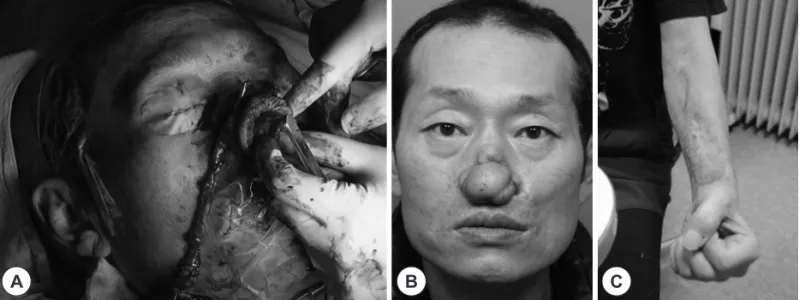 Fig. 2. 1st stage operation. A harvested radial forearm tissue bulk is ready to be transferred to the defect