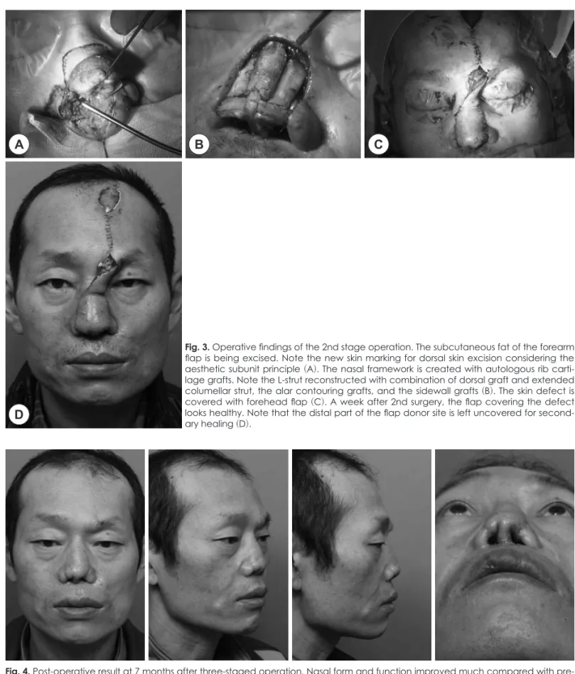 Fig. 3. Operative findings of the 2nd stage operation. The subcutaneous fat of the forearm  flap is being excised