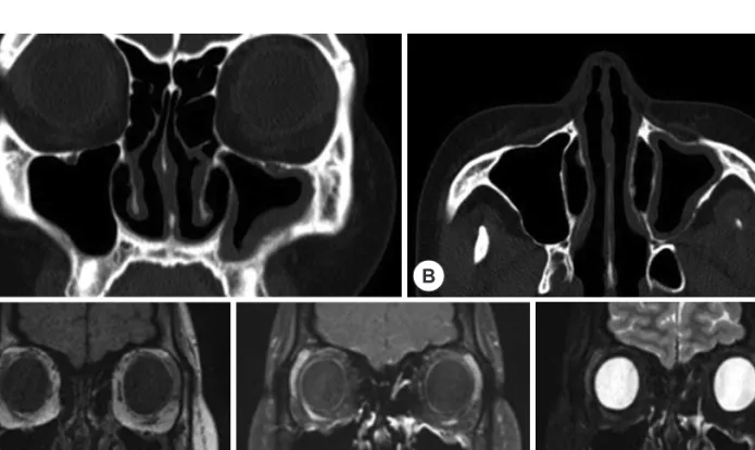 Fig. 2. Radiologic findings. CT image showing mucosal thickening of left maxillary sinus, Coronal view (A)