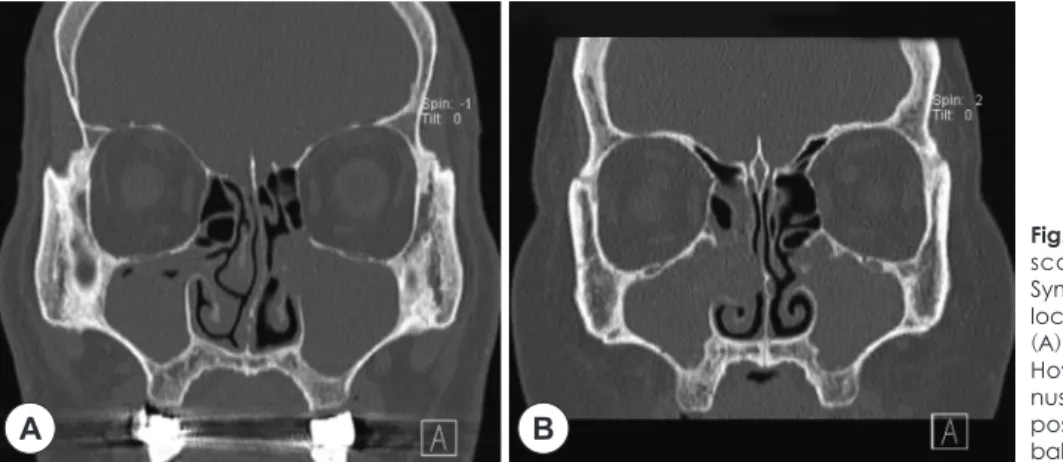 Fig. 1. Preoperative paranasal CT  scans of two cases of bioballs. 