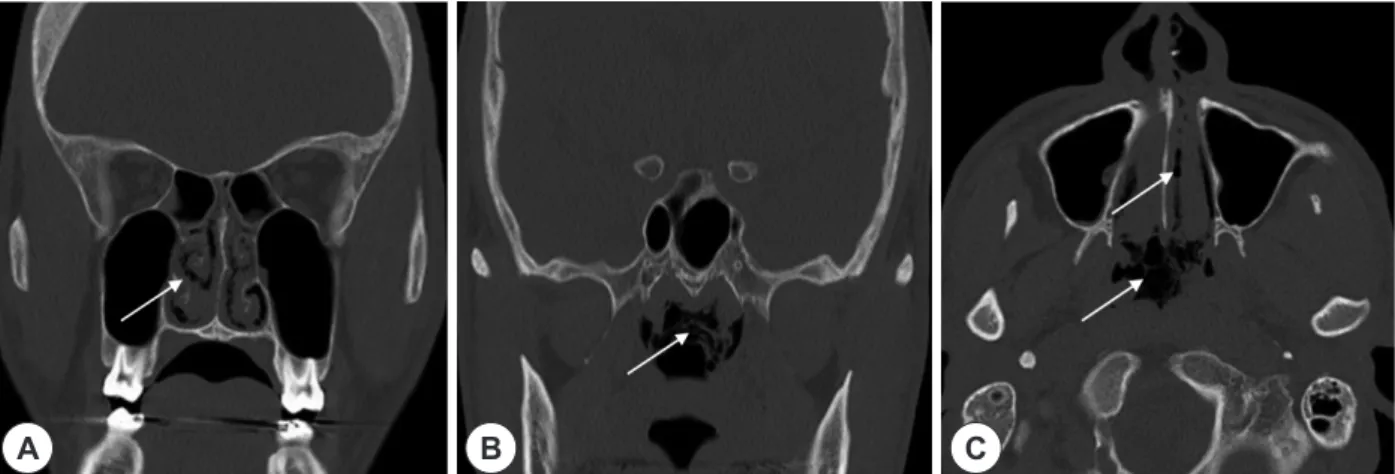 Fig. 2. PNS CT with noncontrast. Soft tissue densities with air bubbles sign (white arrow) were observed in the nasal cavity and the na- na-sopharynx which were shown at coronal view (A), (B) and axial view (C)
