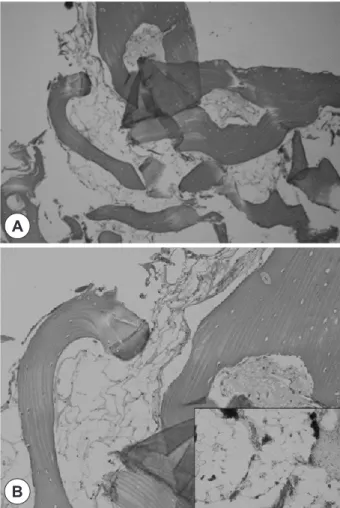 Fig. 2. CT images of the patient. Coronal view (A), Axial view (B). 