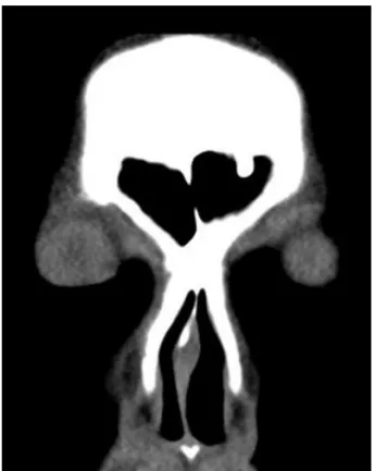 Fig. 1. A coronal view of paranasal sinus computed tomogra- tomogra-phy for high septal deviation: Baumann’s type II.
