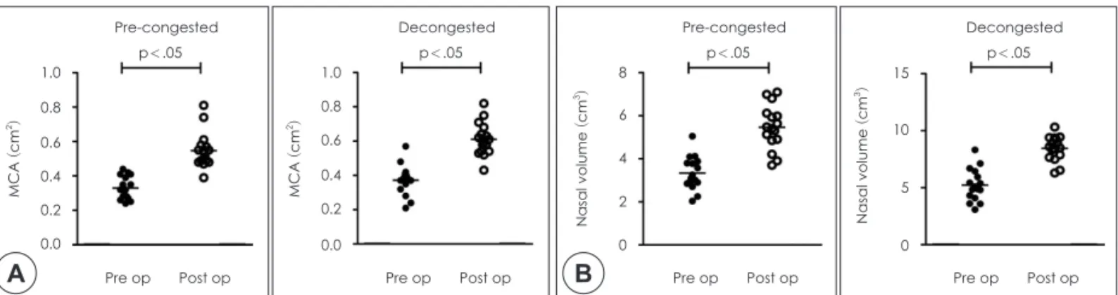 Fig. 5. A: Comparison of pre-operative and post-operative MCA at second notch of concave nasal cavity in patients without high  septal deviation