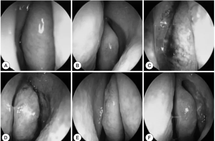 Fig. 3. Endoscopic view of middle meatus before and after balloon sinuplasty. (A) Right middle meatus and (B) Left middle meatus  before balloon sinuplasty