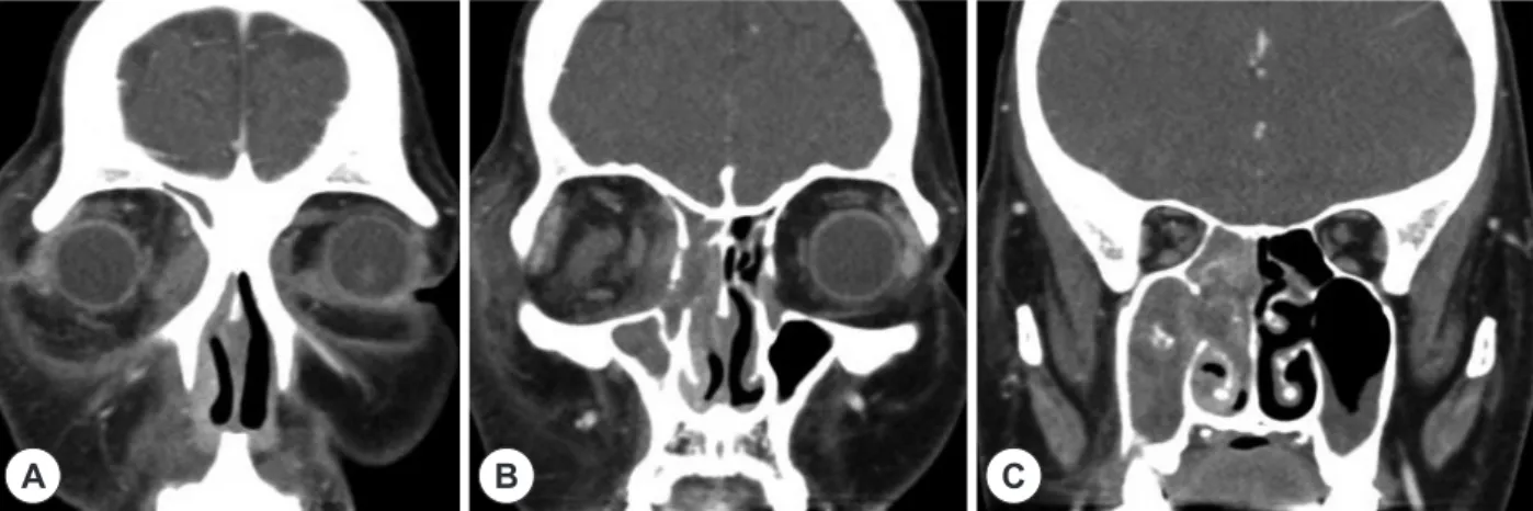 Fig. 1. Coronal, enhanced, Orbit CT findings. CT scan reveal the right periorbital swelling (A) and soft tissue density on the right sino- sino-nasal cavity (B), and nodular calcifications located centrally in the right maxillary sinus (C).