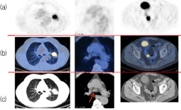 그림 3. CT 영상(c), PET 스캔 영상(a), PET-CT mix 영상(b)[2]